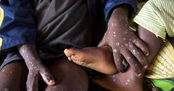 非洲宣布 103 例猴痘死亡，警告其他傳播途徑