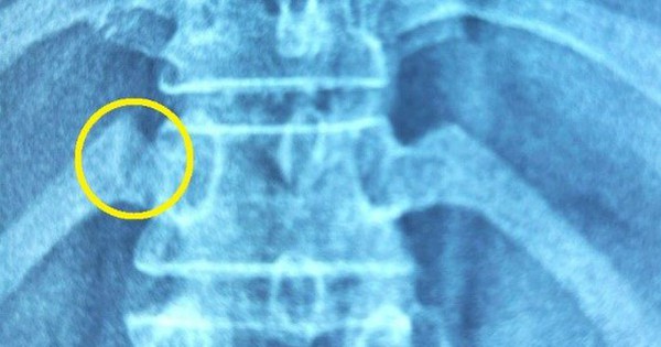 broken-ribs-from-reflexology-broken-joints-thuvienpc