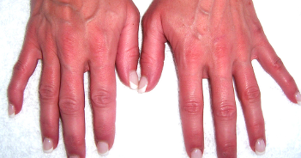 3 BẤT THƯỜNG ở b&agrave;n tay cảnh b&aacute;o bệnh ung thư gan: Nhiều người gặp phải  nhưng chủ quan bỏ qua