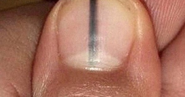 Móng tay xuất hiện sọc đen có phải ung thư da?