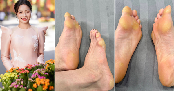 Bàn chân biến dạng của hot girl bóng đá Hoàng Thị Loan gây xôn xao