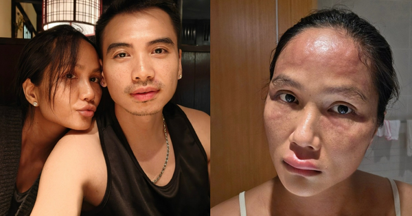 Hoa hậu H"Hen Niê sau khi bị biến dạng mặt