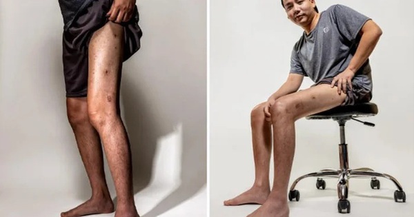 Tình trạng bất ổn của Khoa Pug