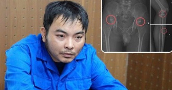 Cựu nhân viên y tế đục vỡ xương trục lợi bảo hiểm: Thủ đoạn tàn nhẫn, bất nhân