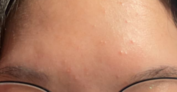 Con gái mọc mụn trứng cá, mẹ xin nghỉ phép đưa con đi cấp cứu