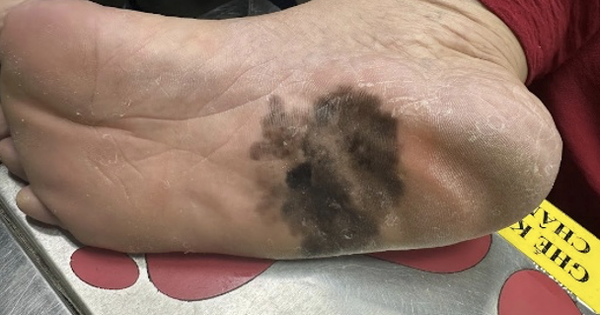 Đốm đen trên da có phải là dấu hiệu ung thư da?