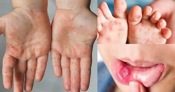 Nguy cơ dịch chồng dịch ở TP.HCM, ghi nhận hơn 3.000 ca một tuần