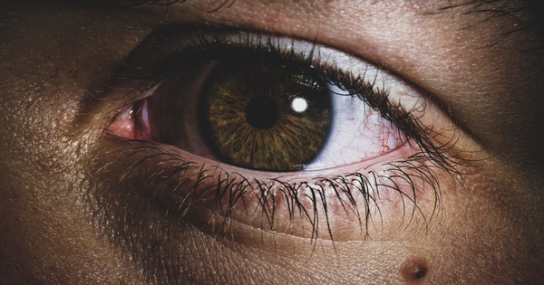 Tưởng nốt ruồi lộc trên mắt hoá ra mắc UNG THƯ DA, bác sĩ sửng sốt: Sai lầm chết người khi coi thường một ‘dấu chấm nhỏ’