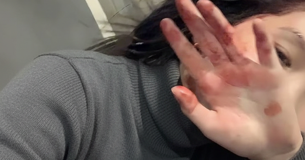 6 bất thường ở bàn tay đang ám chỉ lượng đường trong máu vượt ngưỡng an toàn, tiếc là rất ít người để ý!