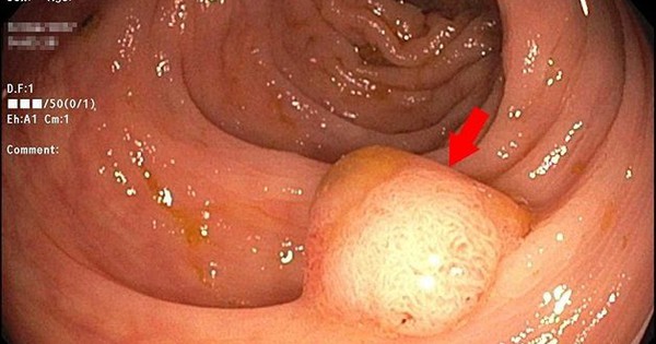 20 tuổi đã suýt bị ung thư đại tràng: Bác sĩ nói người trẻ có 4 dấu hiệu này khi đi vệ sinh phải đi khám gấp