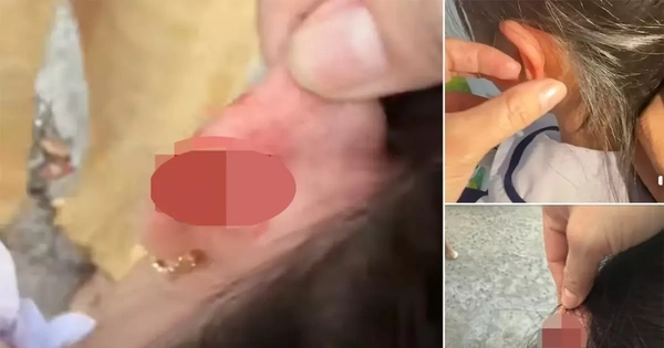 Xác minh vụ giáo viên tiểu học véo tai học sinh lớp 1 chảy máu ở Phú Quốc