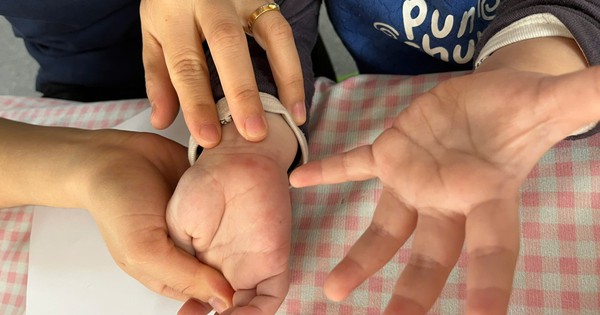 Tưởng con sốt phát ban, bà mẹ tá hỏa khi bác sĩ kết luận tay chân miệng