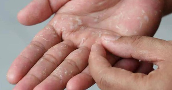 Khổ cả mùa đông vì da tay da chân bong tróc: Thói quen nhiều người vẫn làm mà không nhận ra đang tự làm đau mình