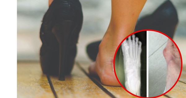 1 dấu hiệu ở bàn chân cảnh báo bệnh lý: Tiếc là chưa nhiều người quan tâm