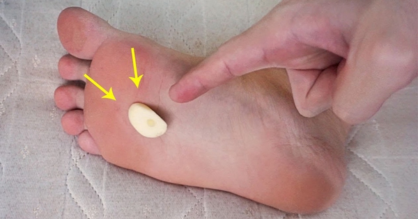 Chà tỏi lên lòng bàn chân, tưởng “vô tri” nhưng mang lại cá tá lợi ích sức khỏe, làm đẹp