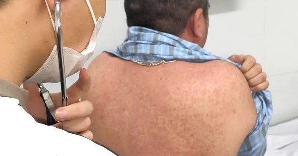 Cả nước ghi nhận hơn 76.300 trường hợp nghi sởi
