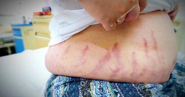 "Con tôi chỉ bị viêm mũi dị ứng thôi mà...": Người mẹ khóc nấc vì không ngờ thói quen xịt mũi lại khiến con bị suy tuyến thượng thận