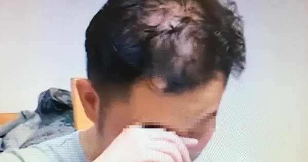 Nam sinh 16 tuổi đã hói nửa đầu vì 1 thói quen khi ngủ người càng trẻ tuổi càng dễ “sa vào bẫy”