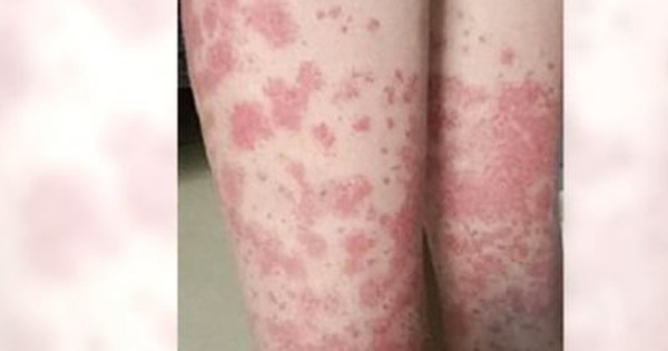 Nữ sinh trả giá đắt vì nhuộm tóc liên tục: Thận chảy máu, phải cạo đầu giữ mạng