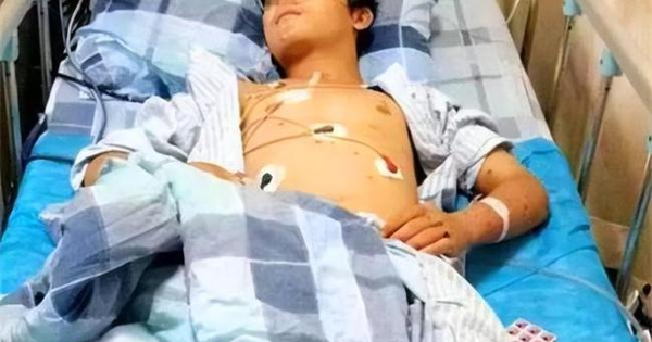 Chàng trai 17 tuổi suy thận giai đoạn cuối vì ăn quá nhiều 2 món nhưng vì "quá ngon" nên không ai từ chối
