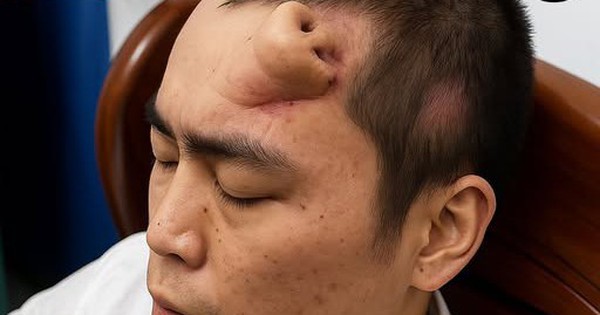 Không phải ảnh lỗi của AI, người đàn ông này đã thực sự mọc một chiếc mũi trên trán: Đó là "tác phẩm" của các bác sĩ Trung Quốc