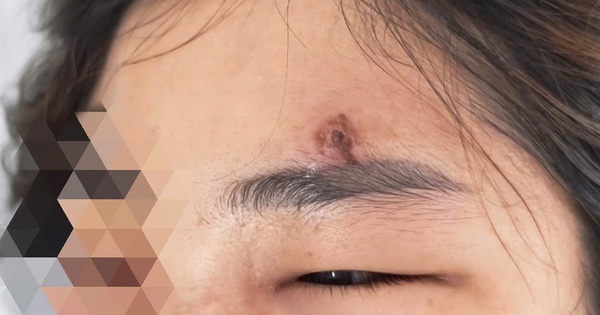 Nặn mụn trứng cá, nữ bệnh nhân nhập viện nguy kịch