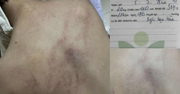 NÓNG - Vụ bé gái 4 tuổi bị cô giáo ném vào tường, đánh tím lưng: Bộ Y tế vào cuộc!