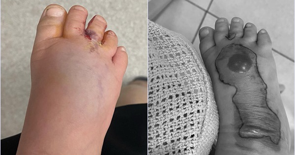 Chỉ một vết mèo cào tưởng vô hại, em bé phải cắt bỏ một phần chân khiến phụ huynh sợ hãi