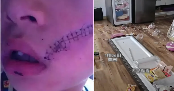 Mở tủ lạnh, bé trai 6 tuổi phải khâu 38 mũi trên mặt