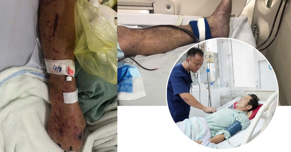 Người đàn ông ở Hưng Yên nguy kịch, tím toàn thân sau chế biến thịt lợn sống, bác sĩ khuyến cáo 3 không