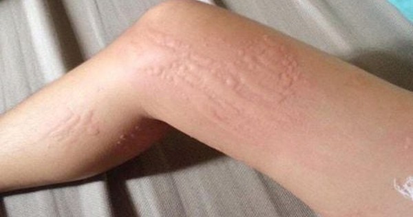 Dị ứng thời tiết: Vì sao bạn bị ngứa, nổi mẩn mỗi khi giao mùa?