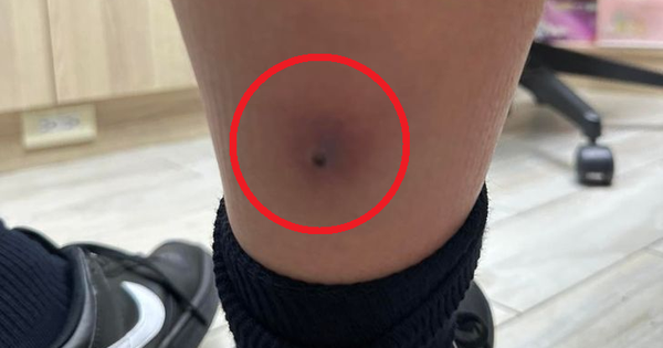 Bé trai 12 tuổi sốt trở lại tưởng cúm, bác sĩ kiểm tra chân phát hiện bệnh nguy kịch