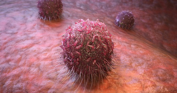 Loại ung thư đứng đầu số ca mắc ở Việt Nam, có thể di căn nhanh: 3 dấu hiệu ban đầu ai cũng nên biết