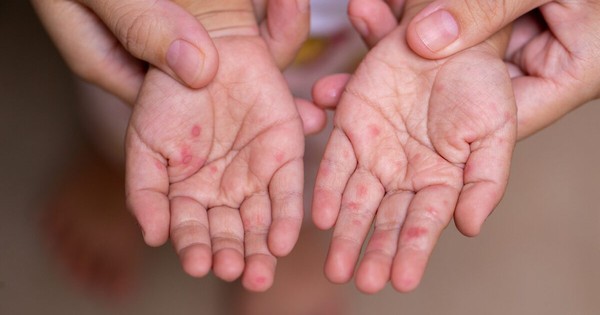 Ba tháng đầu năm ghi nhận gần 25.000 ca tay chân miệng, Bộ Y tế chỉ đạo khẩn