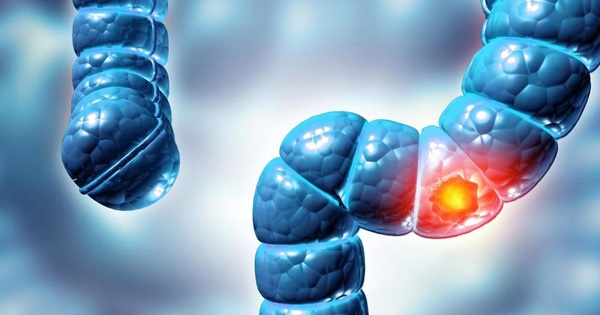 Phát hiện virus mới liên quan loại bệnh ung thư phổ biến