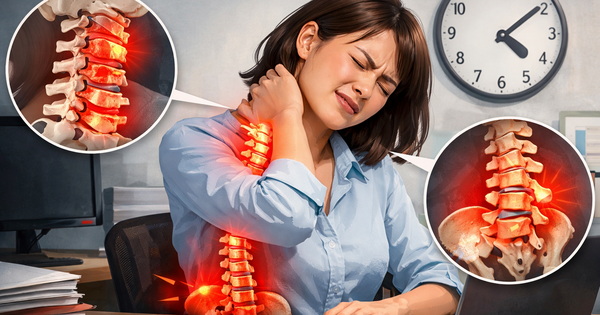 30 tuổi đã thoái hóa đốt sống cổ, bất ngờ 'thủ phạm' bào cột sống dân văn phòng