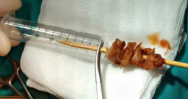 Kích hoạt toàn Bệnh viện Việt Đức cấp cứu bé gái 2,5 tuổi bị que xiên thịt đâm sâu, nguy cơ xuyên sọ não