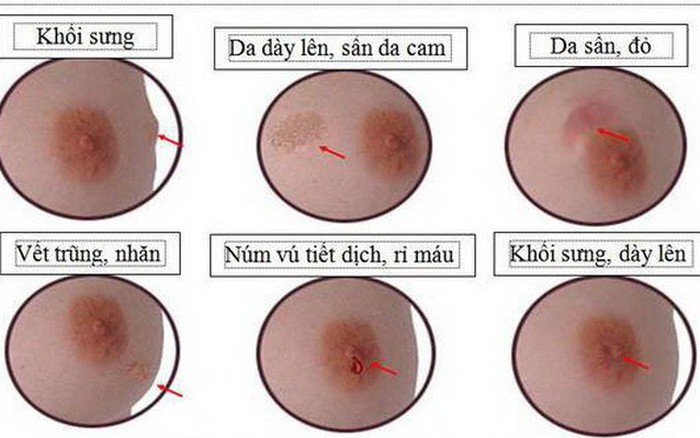 BẢNG THỐNG KÊ TỈ LỆ UNG THƯ VÚ Ở THANH THIẾU NIÊN THEO GIỚI TÍNH