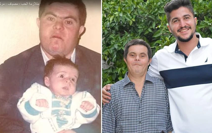 Cảm động câu chuyện bố mắc bệnh Down nuôi dạy con thành bác sĩ