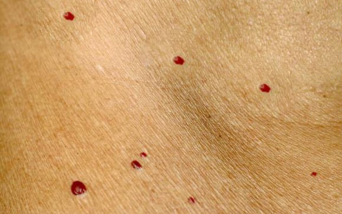 Nốt ruồi đỏ” nhiều khi chẳng phải phúc mà là hoạ, nếu thấy cơ thể xuất hiện  loại nốt ruồi đỏ này cần đi khám ngay