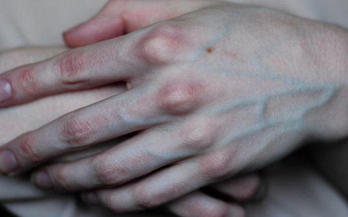 G&acirc;n xanh nổi r&otilde; ở 3 vị tr&iacute; n&agrave;y cảnh b&aacute;o cơ thể đang mang bệnh: Nguy hiểm,  đừng chủ quan m&agrave; bỏ qua