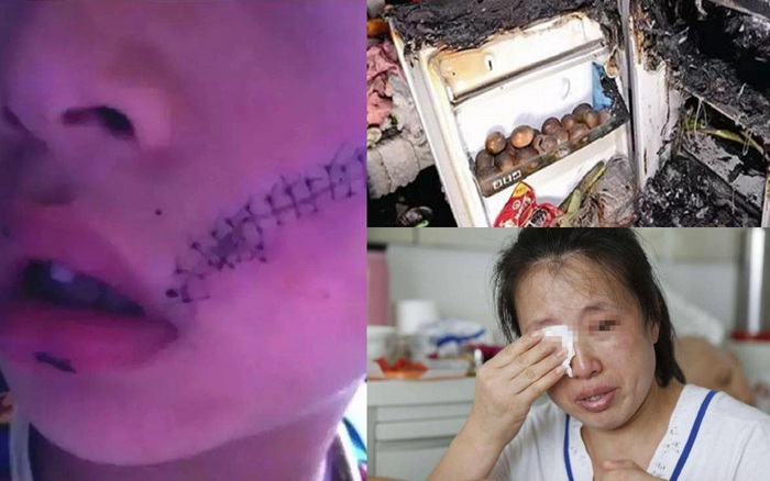 Cậu bé phải khâu 38 mũi do tủ lạnh bất ngờ phát nổ: Cảnh báo, không muốn hiểm họa xảy ra đừng đặt những thứ này vào ngăn đá