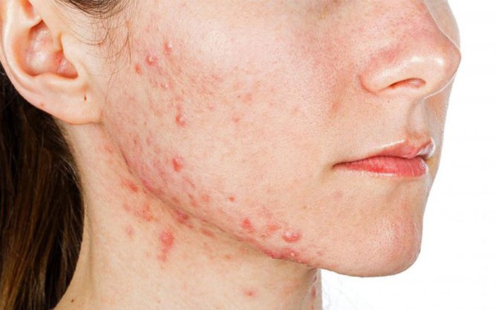 Dấu hiệu cảnh báo cơ thể đang tích tụ đầy độc tố, cần giải độc ngay