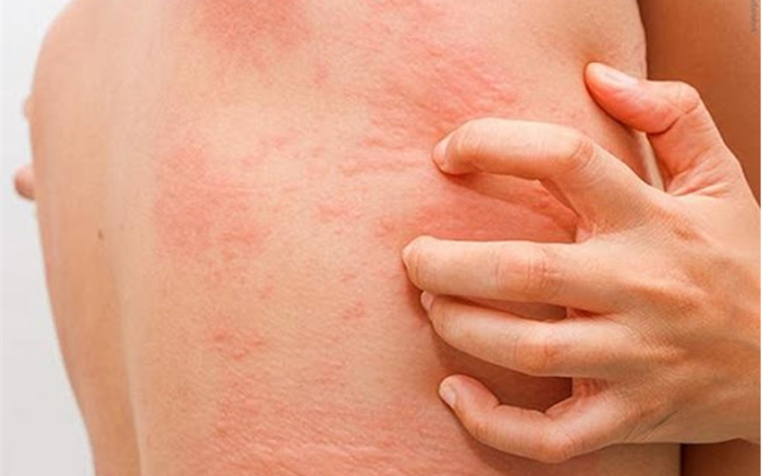 Thấy v&agrave;ng da k&egrave;m ngứa, người phụ nữ đi kh&aacute;m ph&aacute;t hiện mắc 2 loại ung thư: Bệnh  viện Bạch Mai n&oacute;i qu&aacute; hiếm gặp, th&aacute;ch thức trong chẩn đo&aacute;n